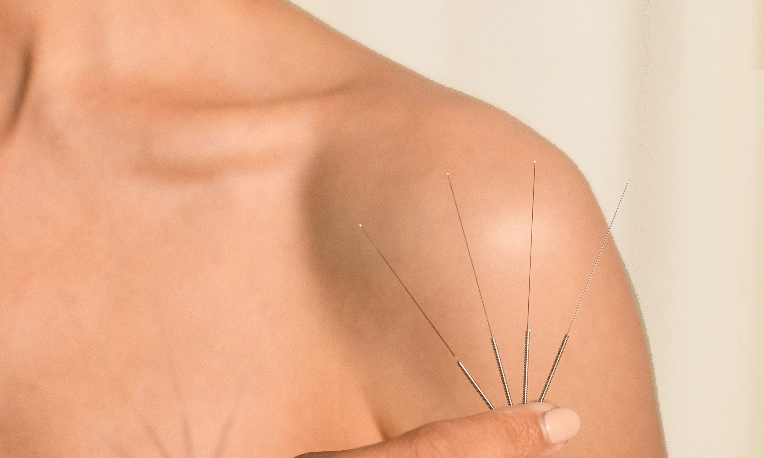 Acupuncture needles being placed along a woman's shoulder
