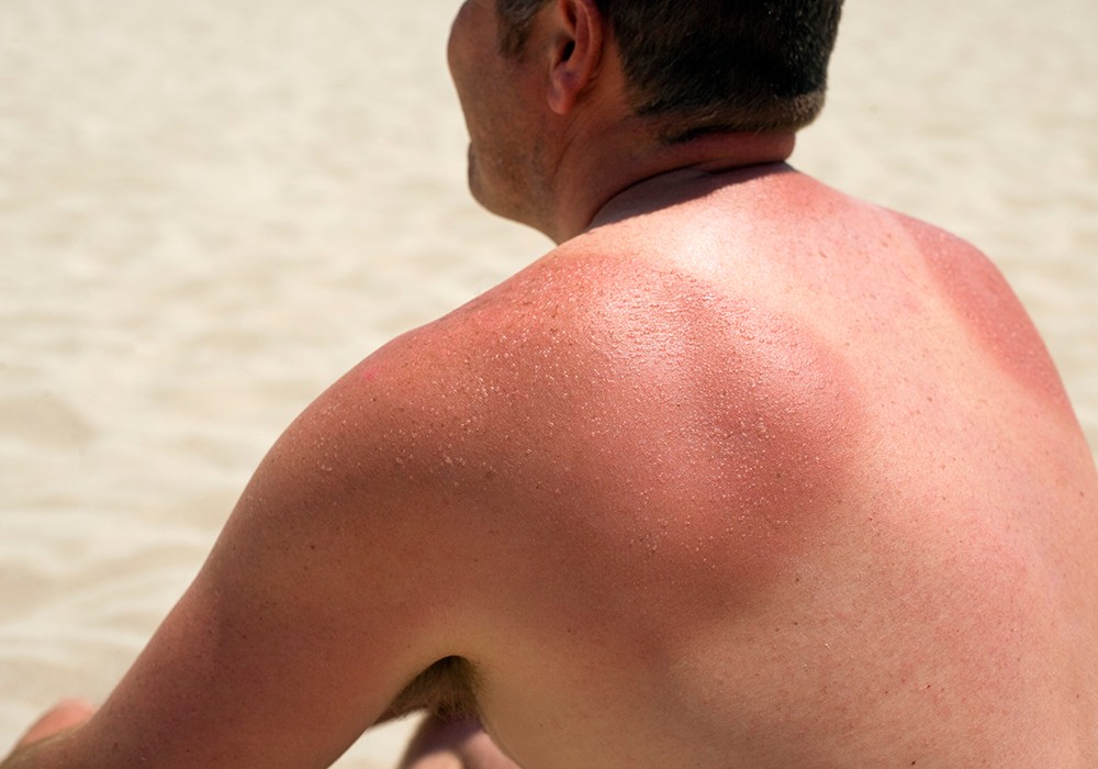 tanning during summer skin changes sunburn