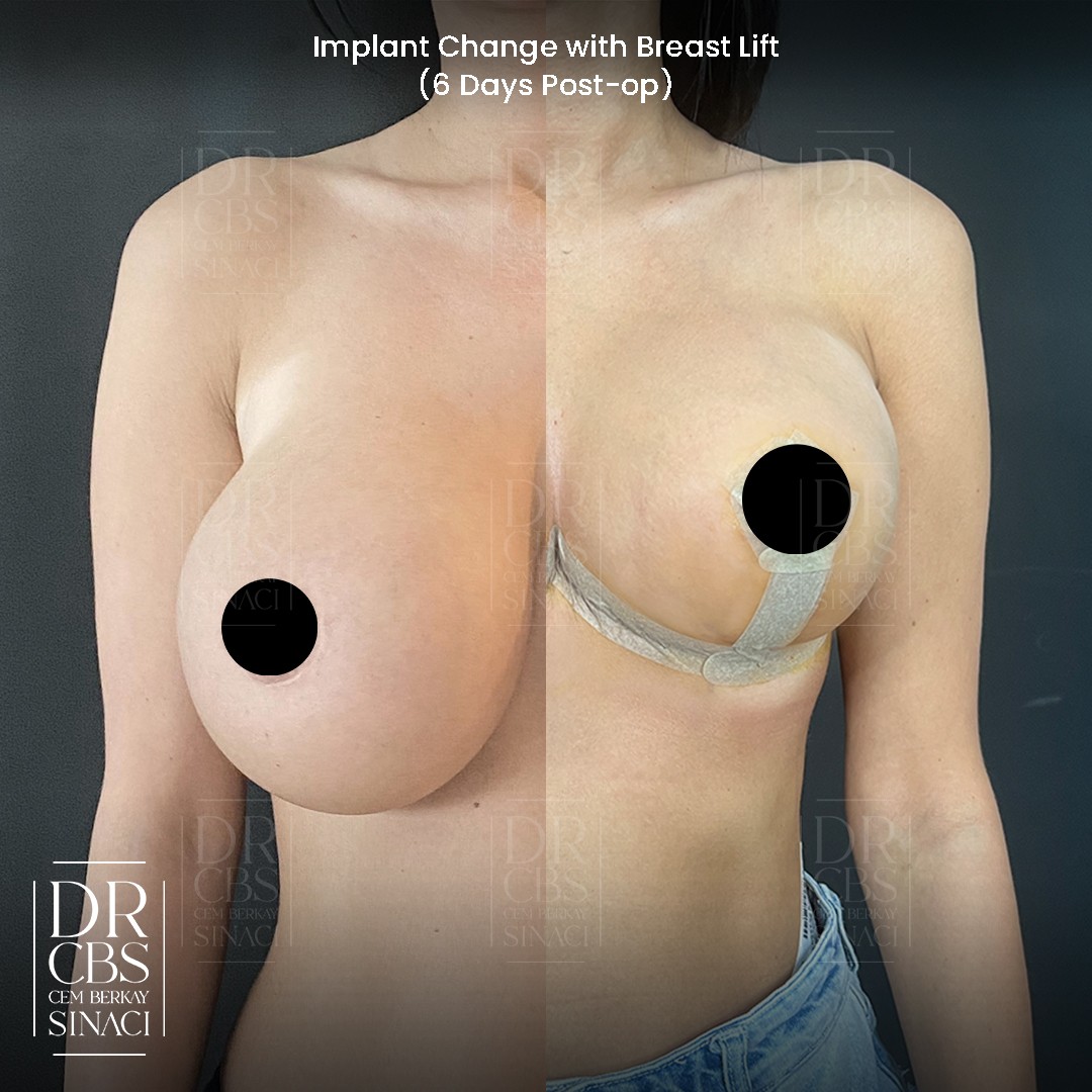 breast implant change with breast lift 6 days post-operative before after front view