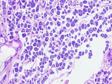 As células neoplásicas são redondas a ovais, com acentuado acúmulo de grânulos metacromáticos intracitoplasmáticos