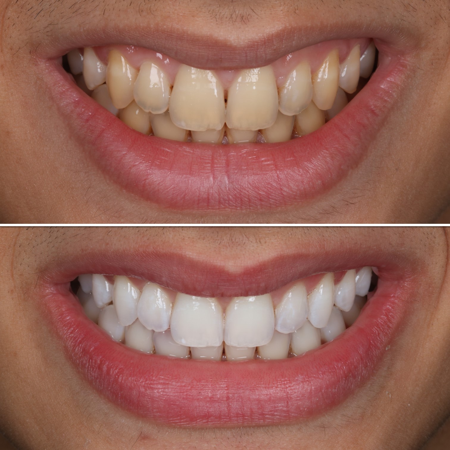 Fotos antes e depois de um sorriso.