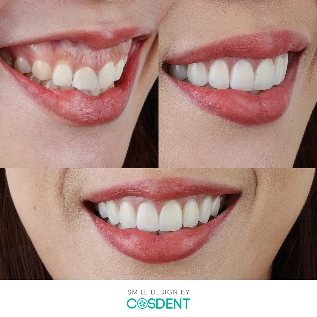 รีวิวออกแบบรอยยิ้ม ที่ cosdent smile design