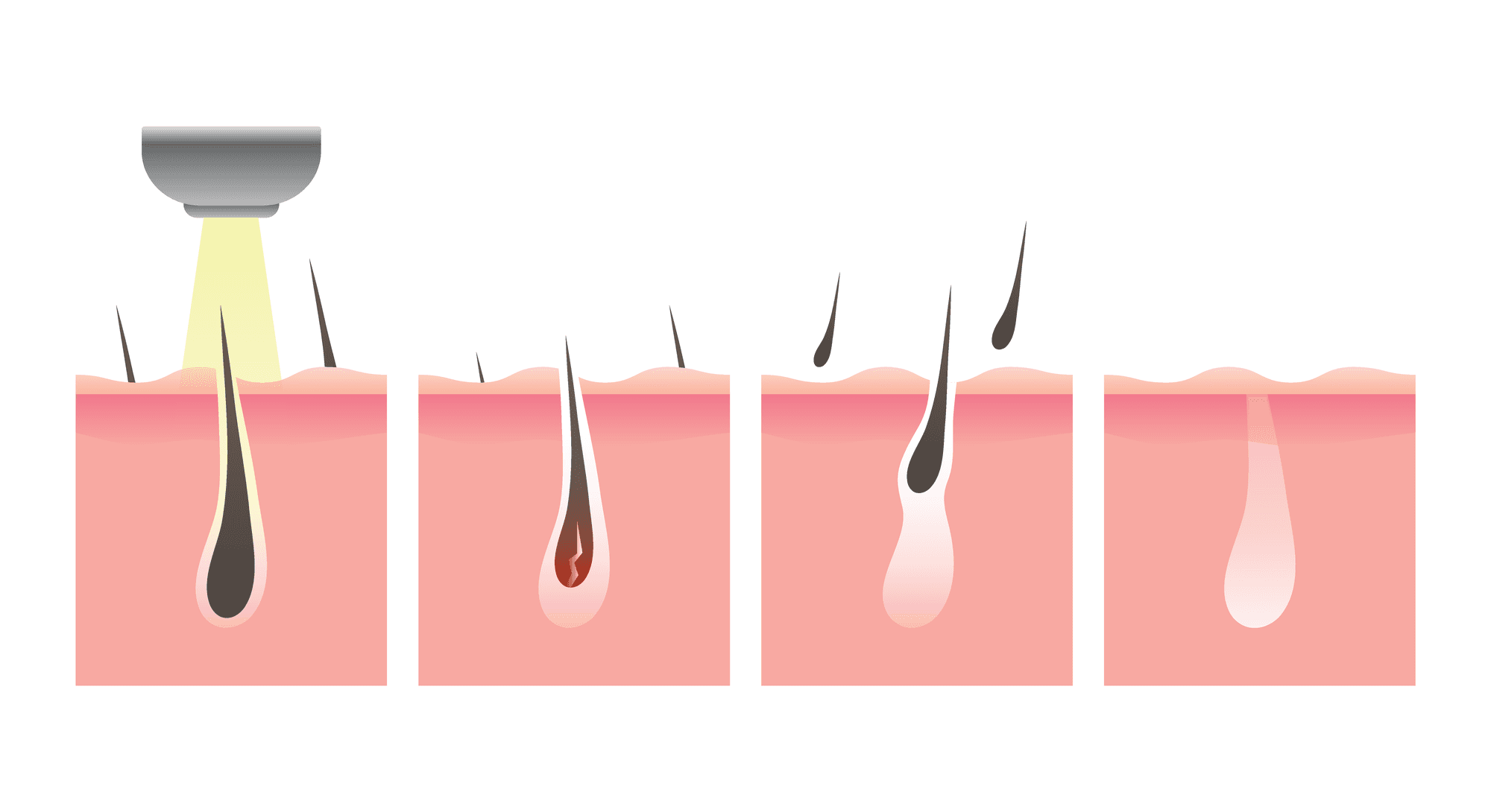 Illustration: die Phasen des Haarzyklus