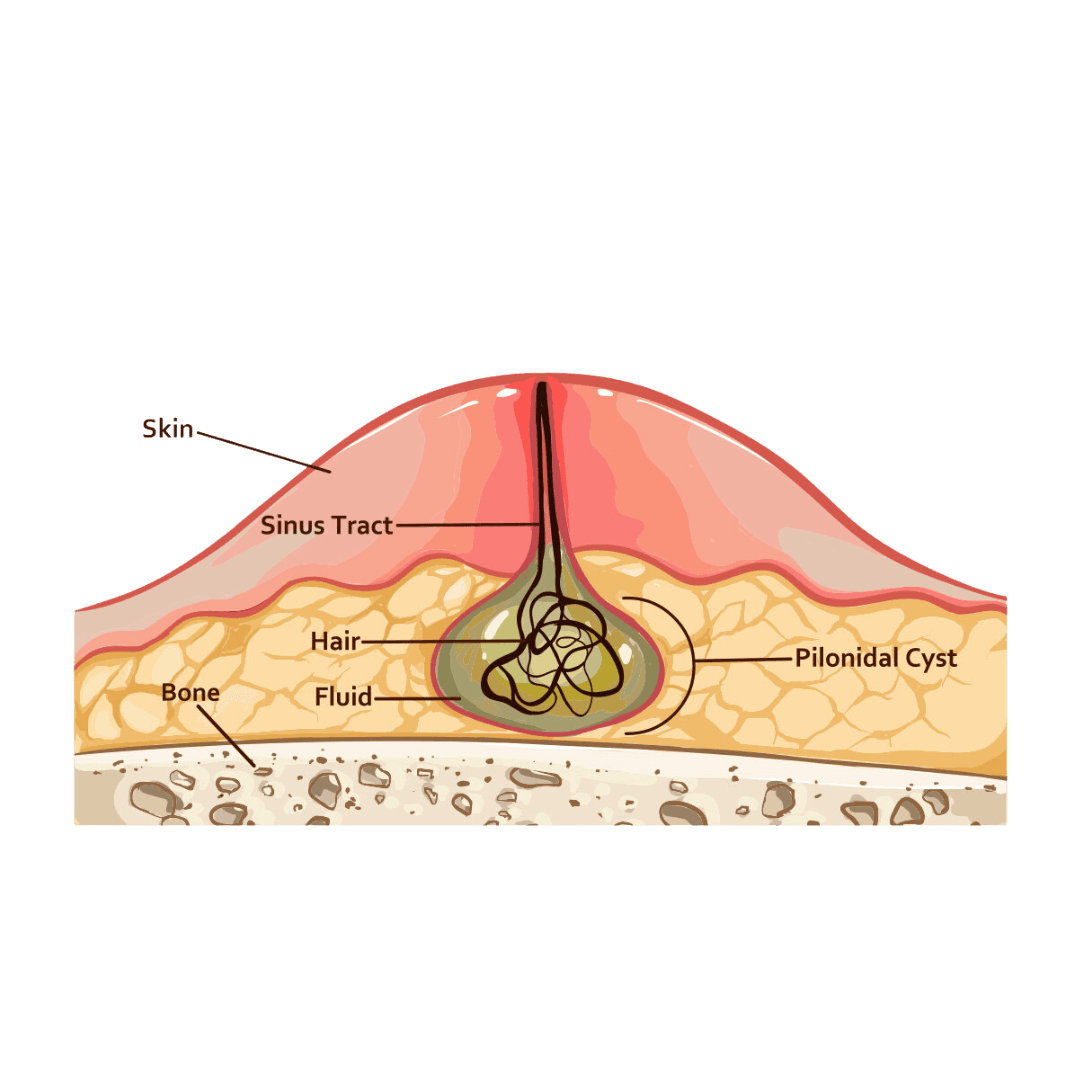 Illustration d'un kyste pilonidal