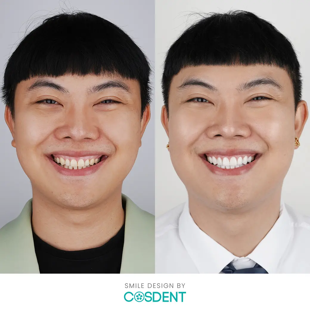 คุณ เป้ย befor and after ออกแบบรอยยิ้มวีเนียร์ cosdent smile design