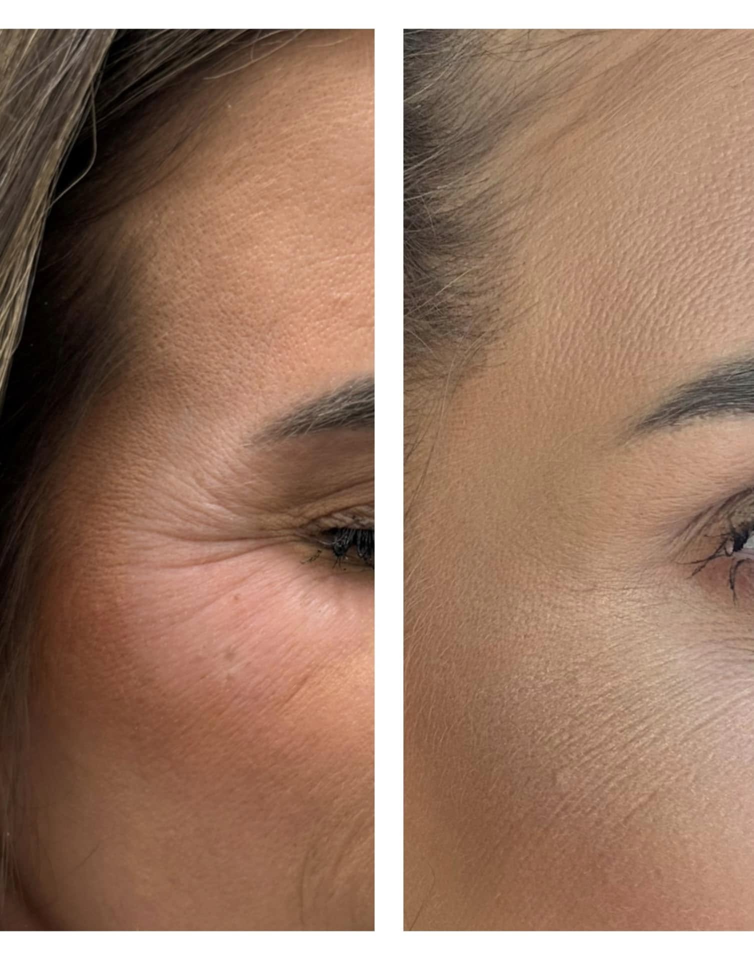 Womens Botox hagerstown md