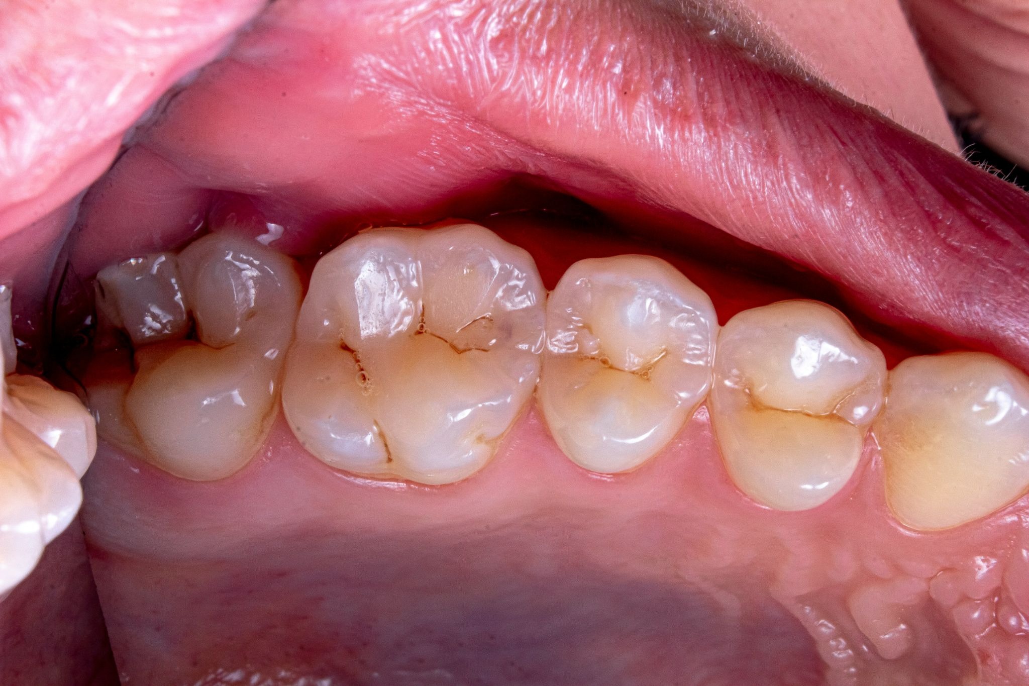Tooth Decay Treatment&nbsp;