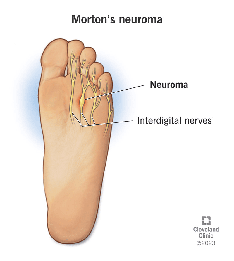 Illustration of Neuroma Treatment