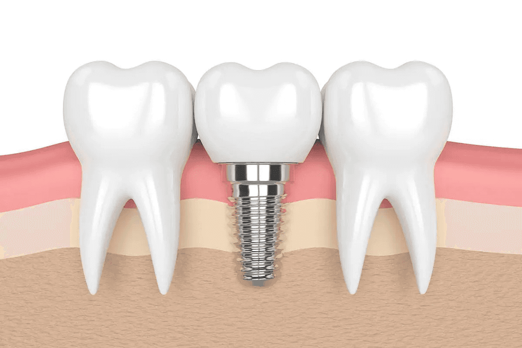 dental crown and bridges in Central Hong Kong 