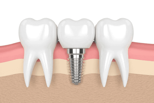 dental implant service