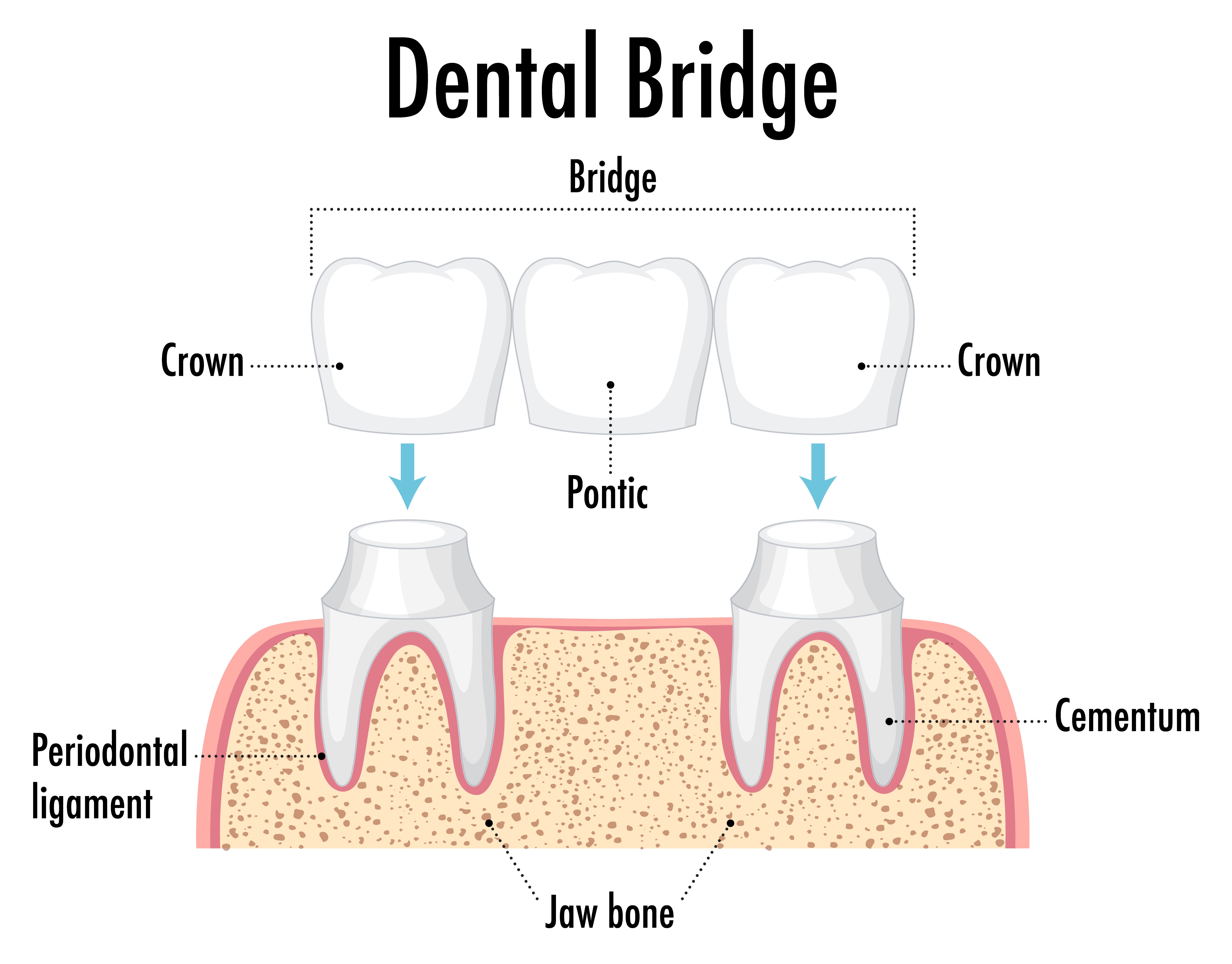 dental bridges