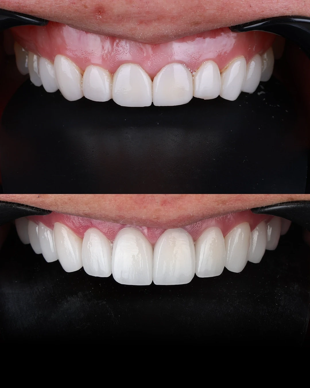 Two close-up views comparing the shape and appearance of upper front teeth.
