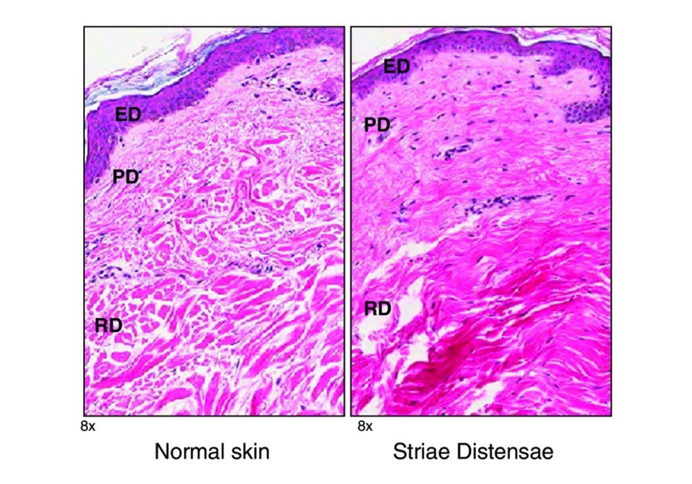 striae distensae comparison chart with normal skin tissue