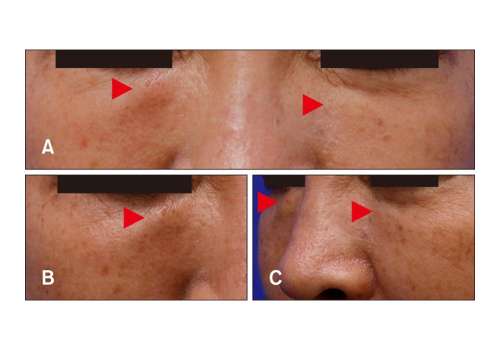 [Late Onset Foreign Body Reaction due to Poly-L-Lactic Acid Facial Injections for Cosmetic Purpose]