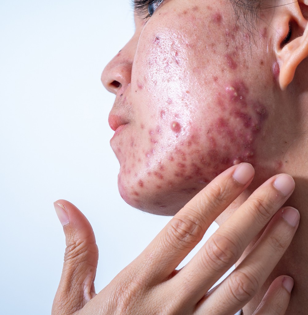 Severe Acne Treatments