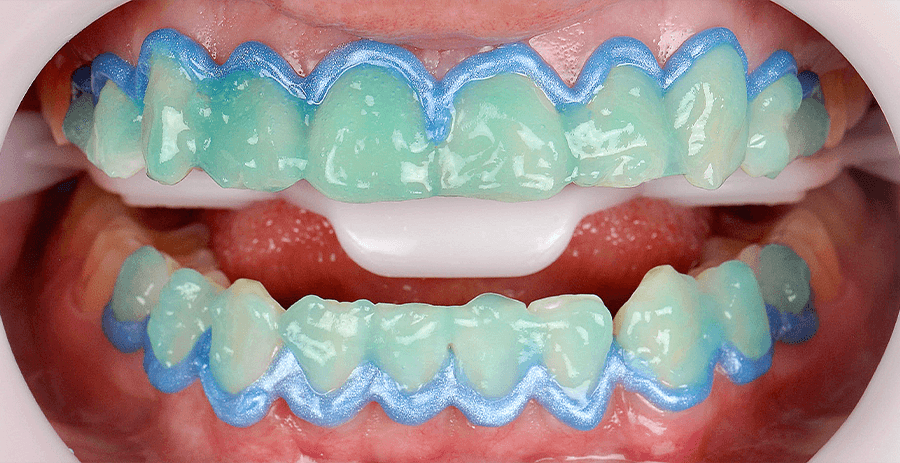 Clareamento de dentes