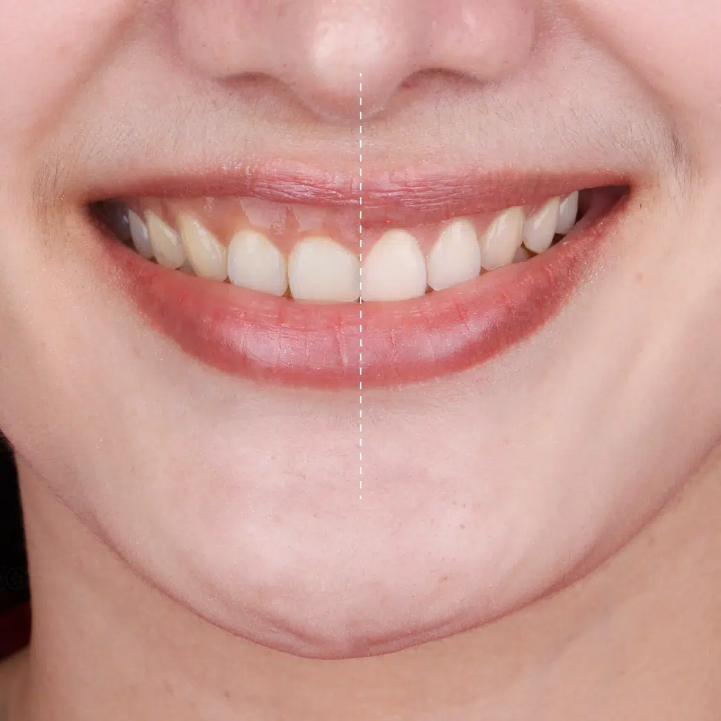 Gum Contouring cosmetic dentistry treatment at Cosdent Bangkok cover image cosdent smile design