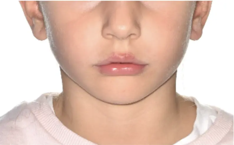 Before and after comparison: more relaxed smile, less muscle tension after “unblocking” the deep bite and “releasing” the lower jaw forward. Profile changes, better lip competence.