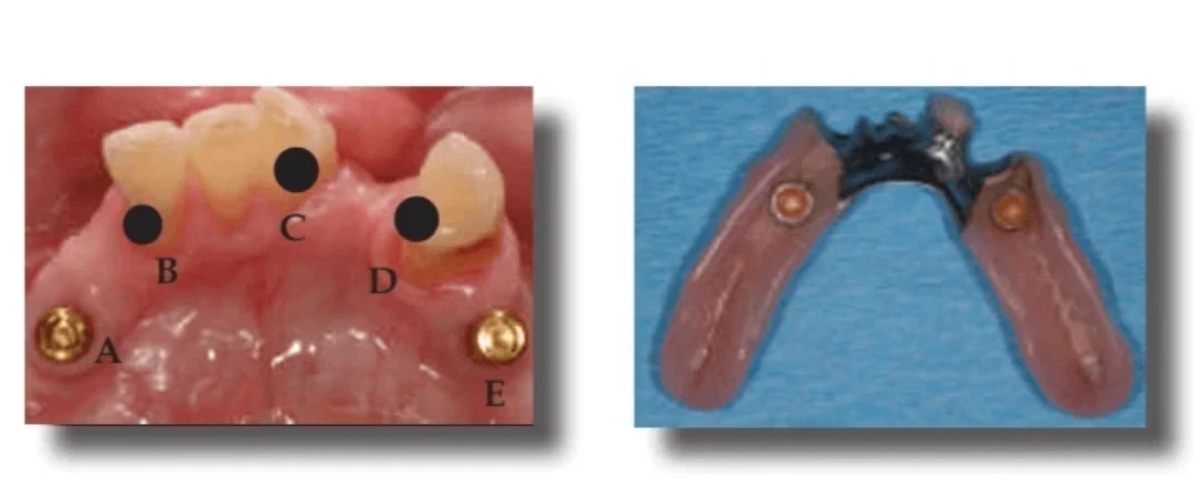 Strategic Placement of Implants for the Future | Bloor-Yorkville Periodontics