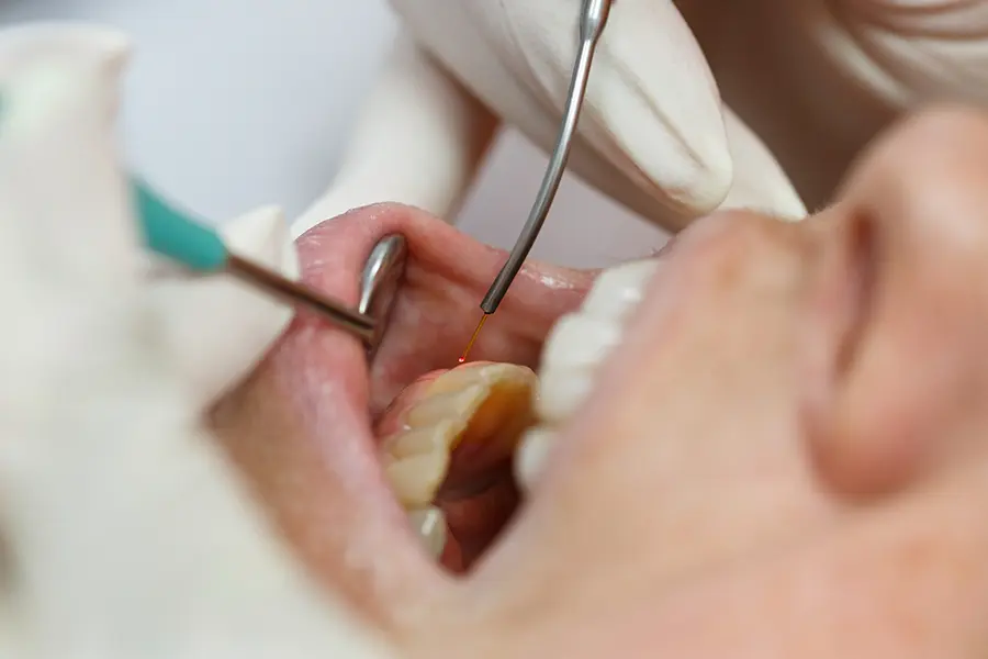 Biolase Epic Laser treatment for comfort of child