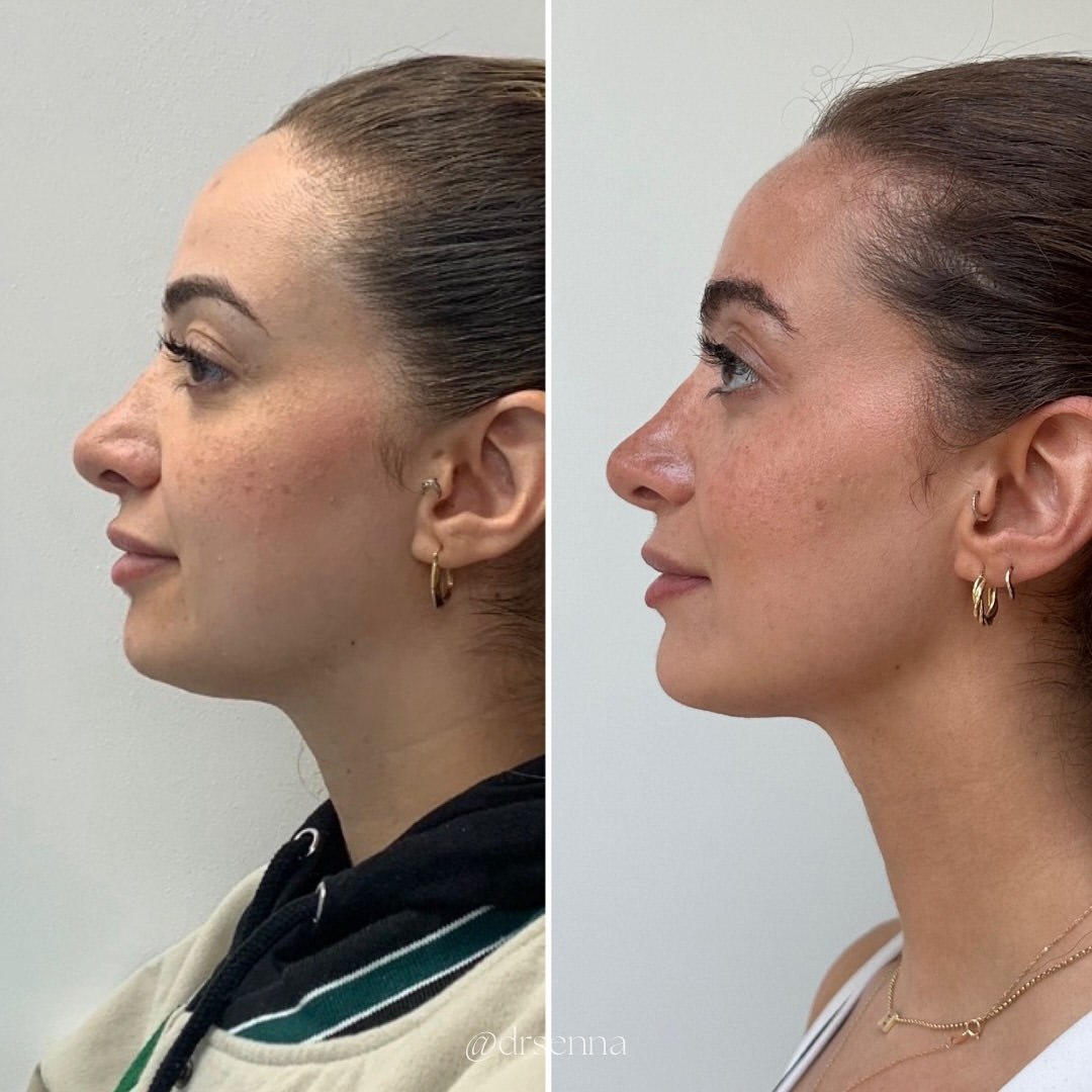 Before and after side profile following HIFU treatment