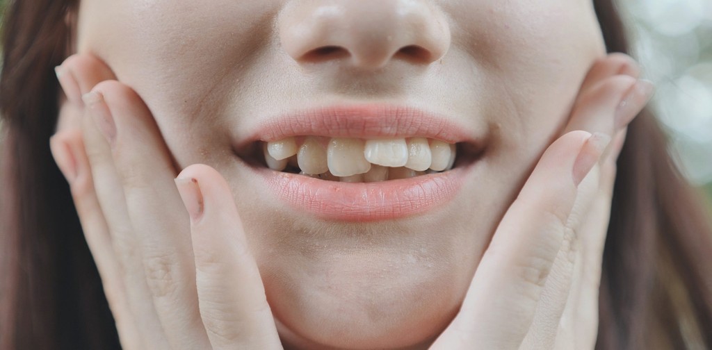 Uneven Teeth