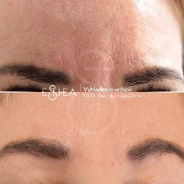 Porovnanie pred a po odstránení vrásky hnevu botulotoxínom Dysport – uvoľnený a omladený výraz tváre