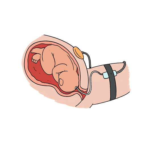 An illustration of a cross-section of a baby in a womb with a small clip (fetal scalp electrode) attached to their head with a wire extending out of the vagina and it strapped to a leg to measure baby's heart rate.  A flat probe is placed on the pregnant belly with a wire attached to it to measure contractions.