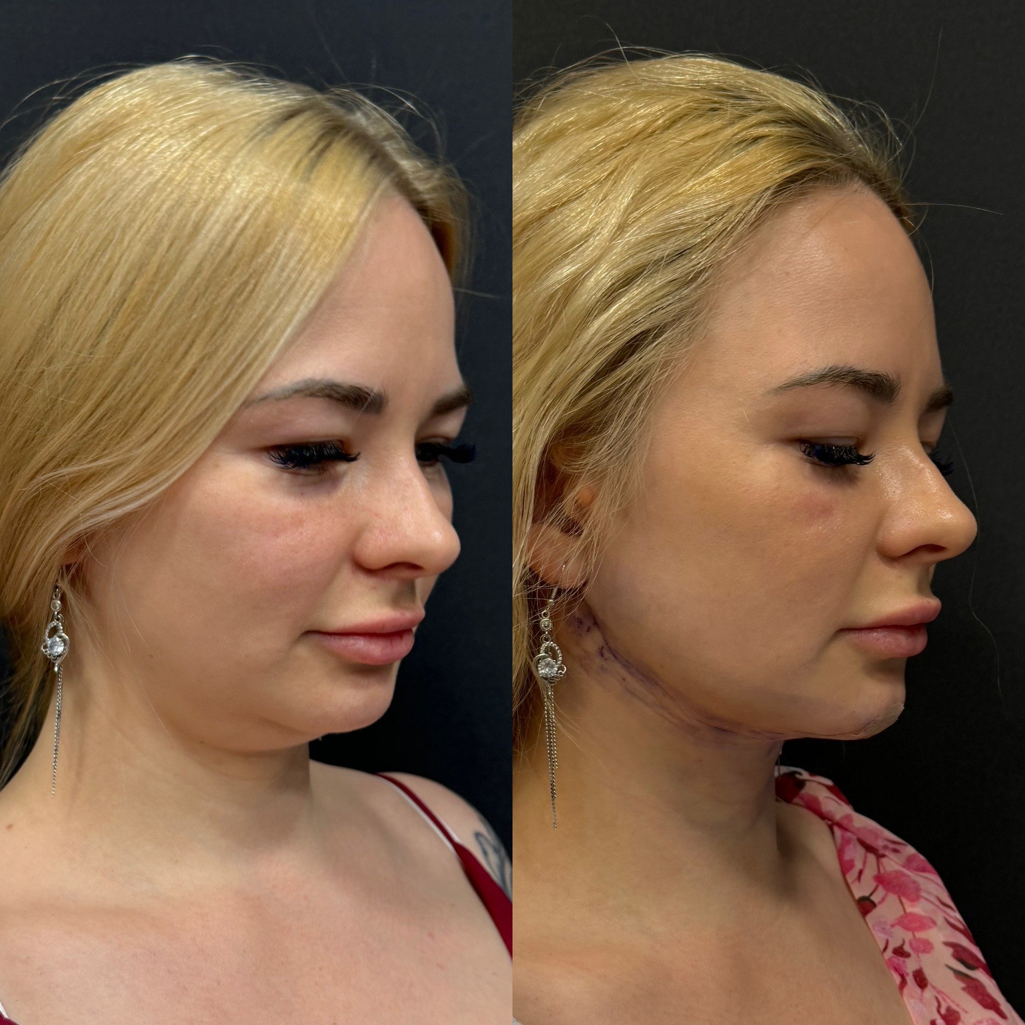 double chin liposuction before after 1 day post-surgery oblique view