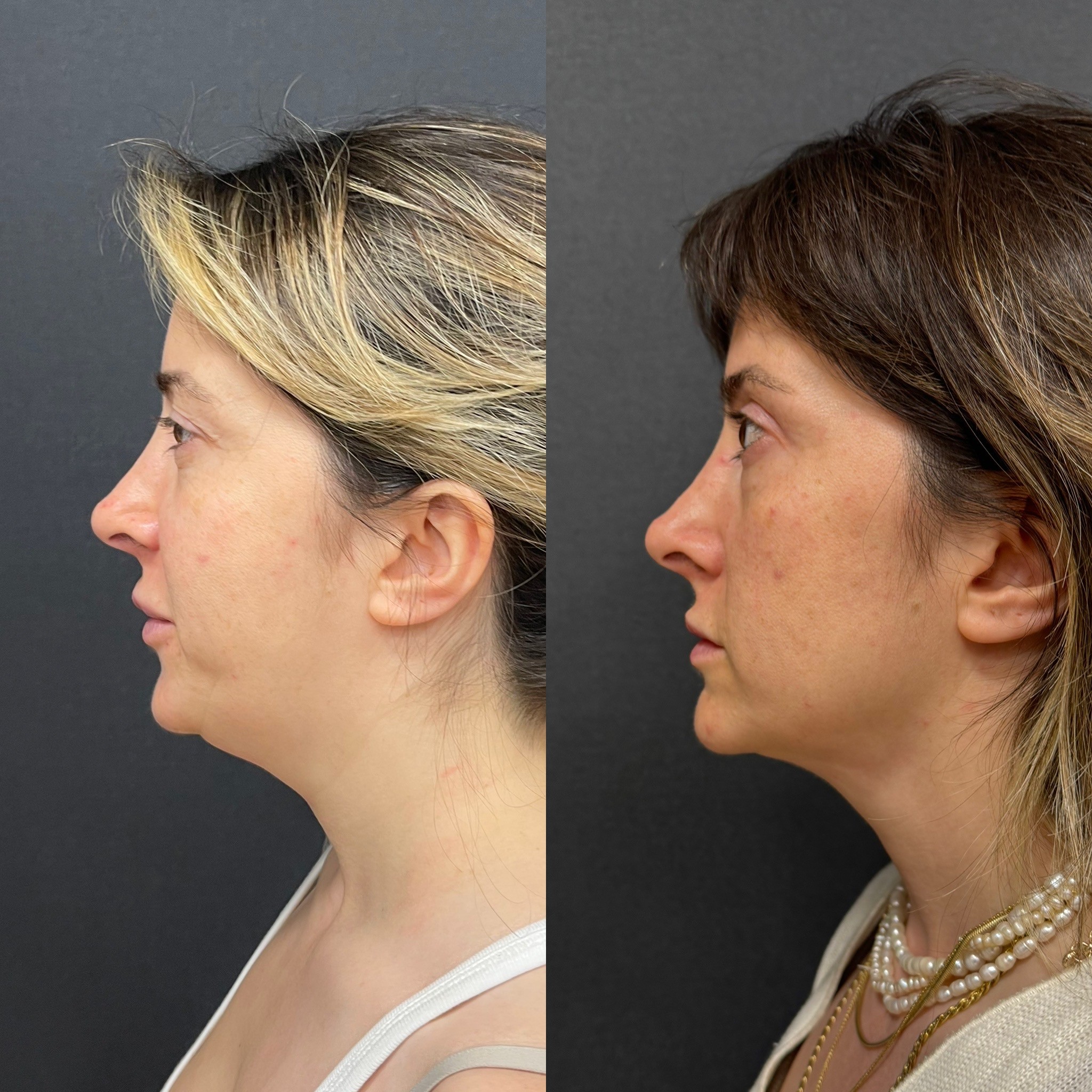 turkey neck deformiy chin laser liposuction before after