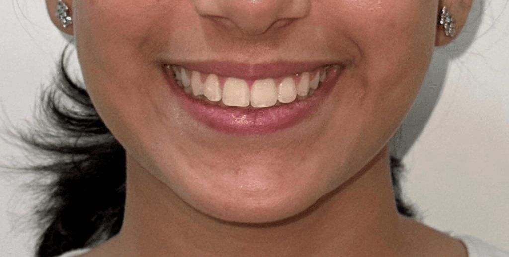 Teeth Whitening