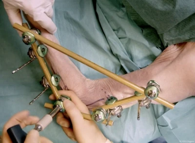 Elbow spanning external fixation