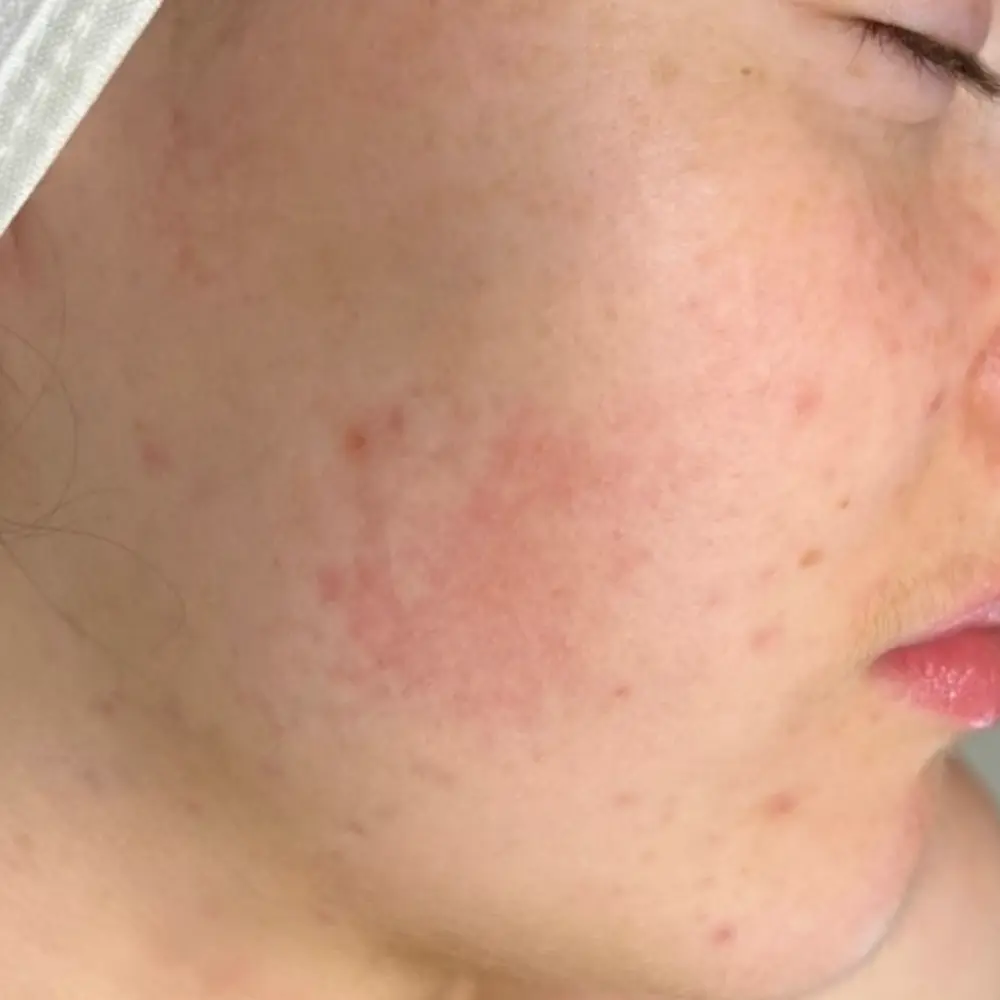 After redness and rosacea treatment at The Vancouver Aesthetician — rosacea and facial redness significantly calmed and skin tone visibly more even and settled