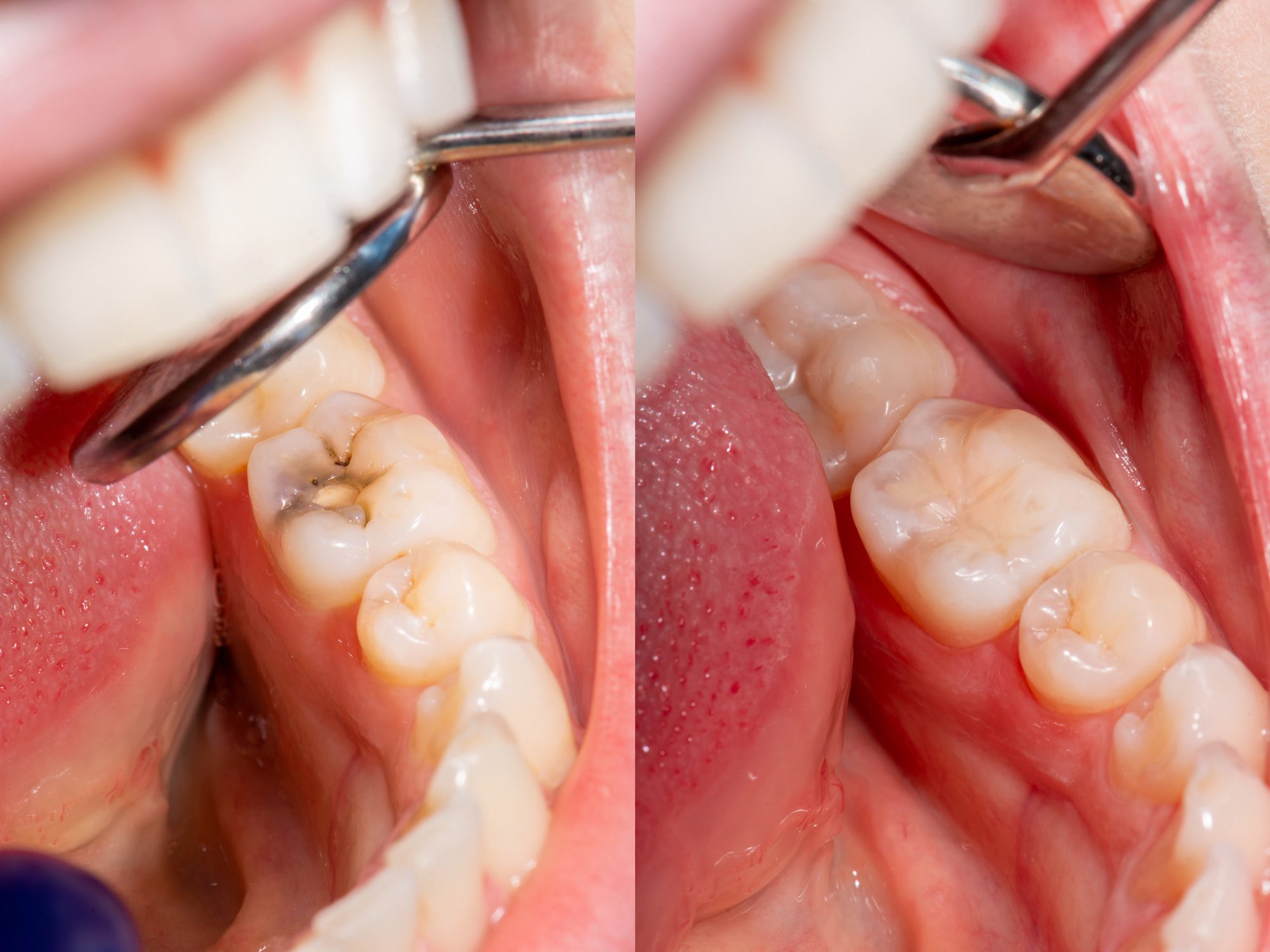 dental composite