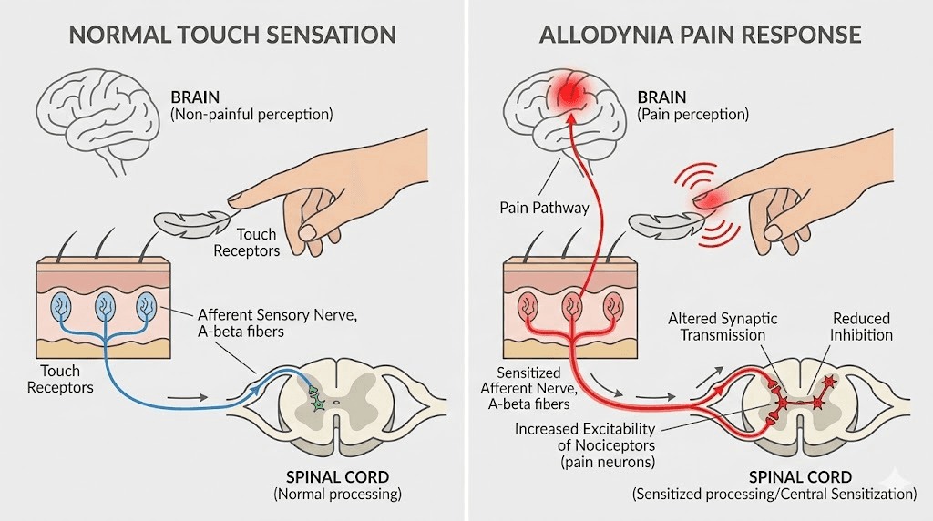 Allodynia nerve pathway diagram showing how normal touch becomes painful with semaglutide