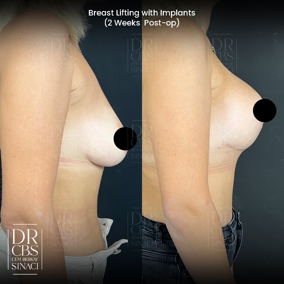 breast lift with implant before after 2 weeks post-operative side view 