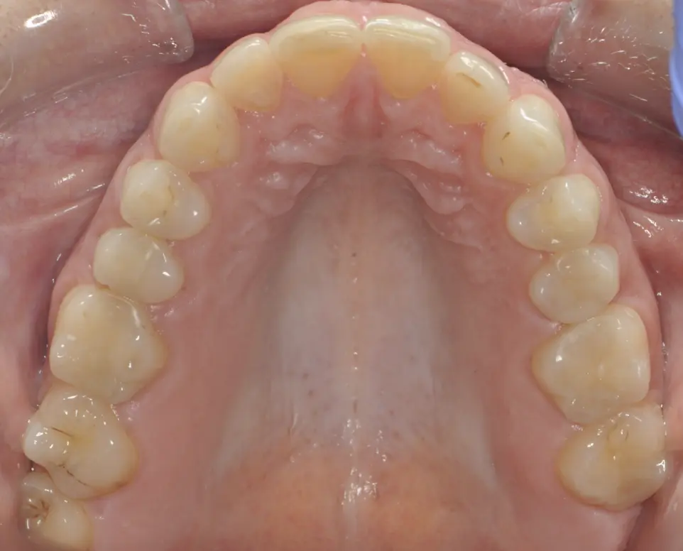 &nbsp;&nbsp;Before ortho treatment