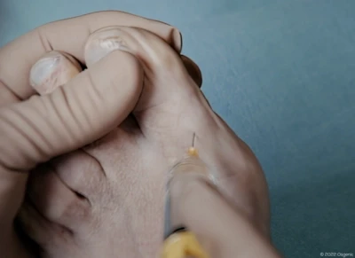 Digital Nerve Block - Toe