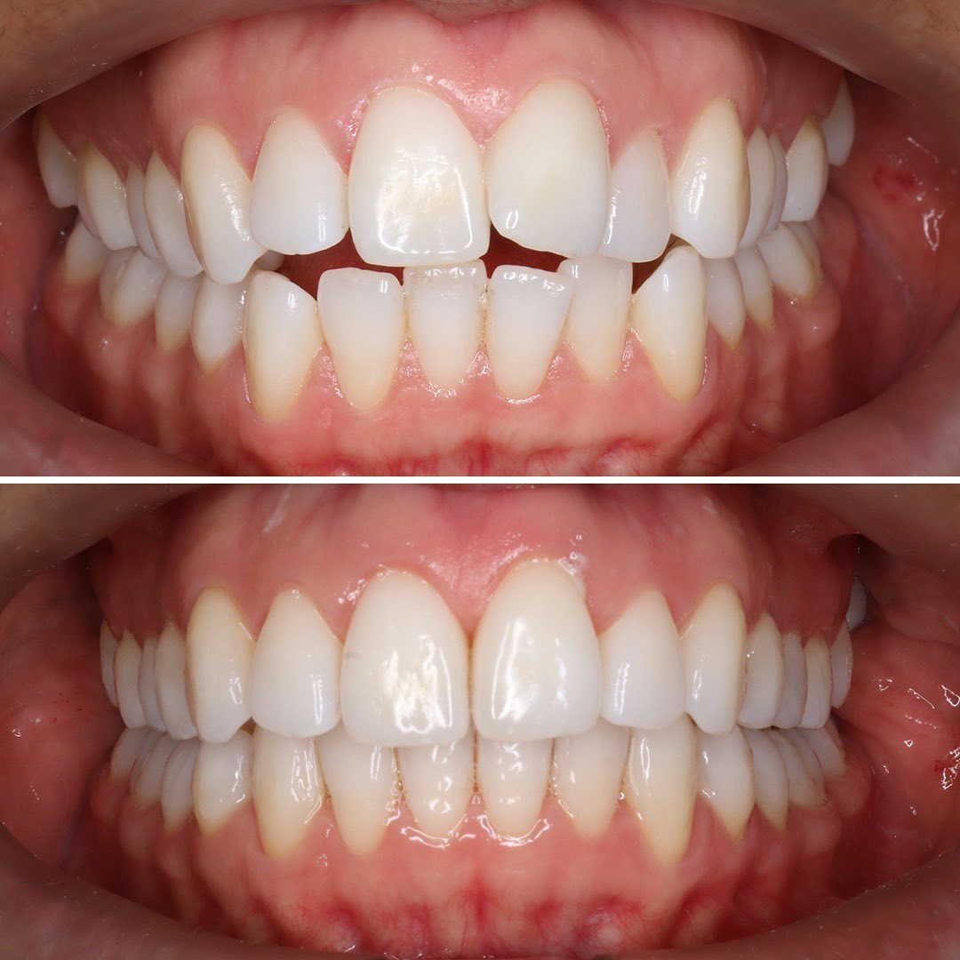 Invisalign before and after photo of teeth featuring a clear transformation from open bite to aligned teeth at Invisalign Center.