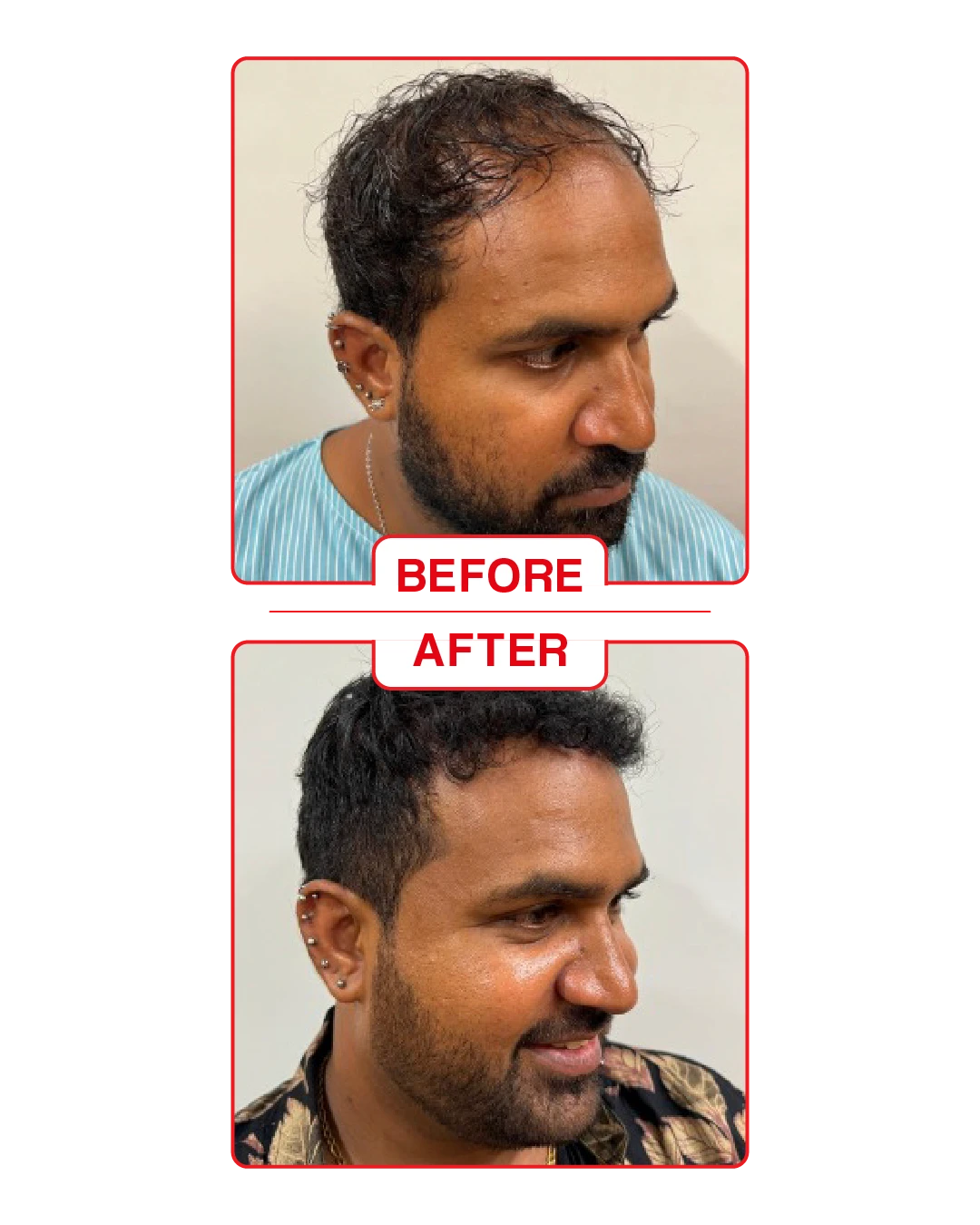 Hair Transplant in Goa