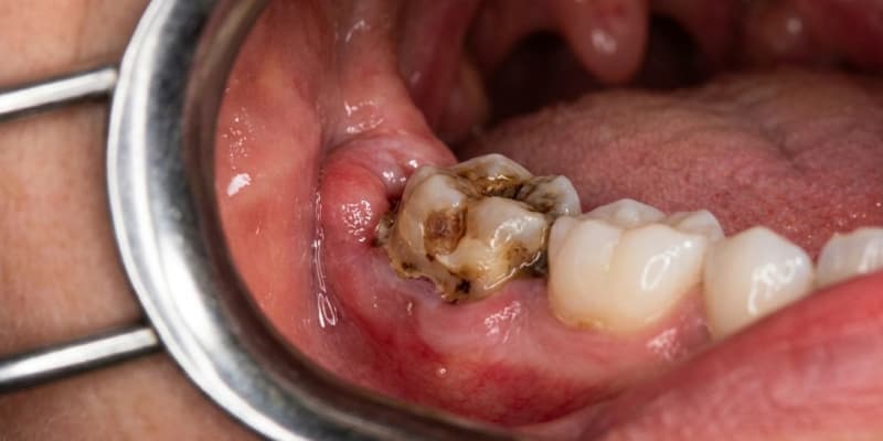 Хворий зуб мудрості