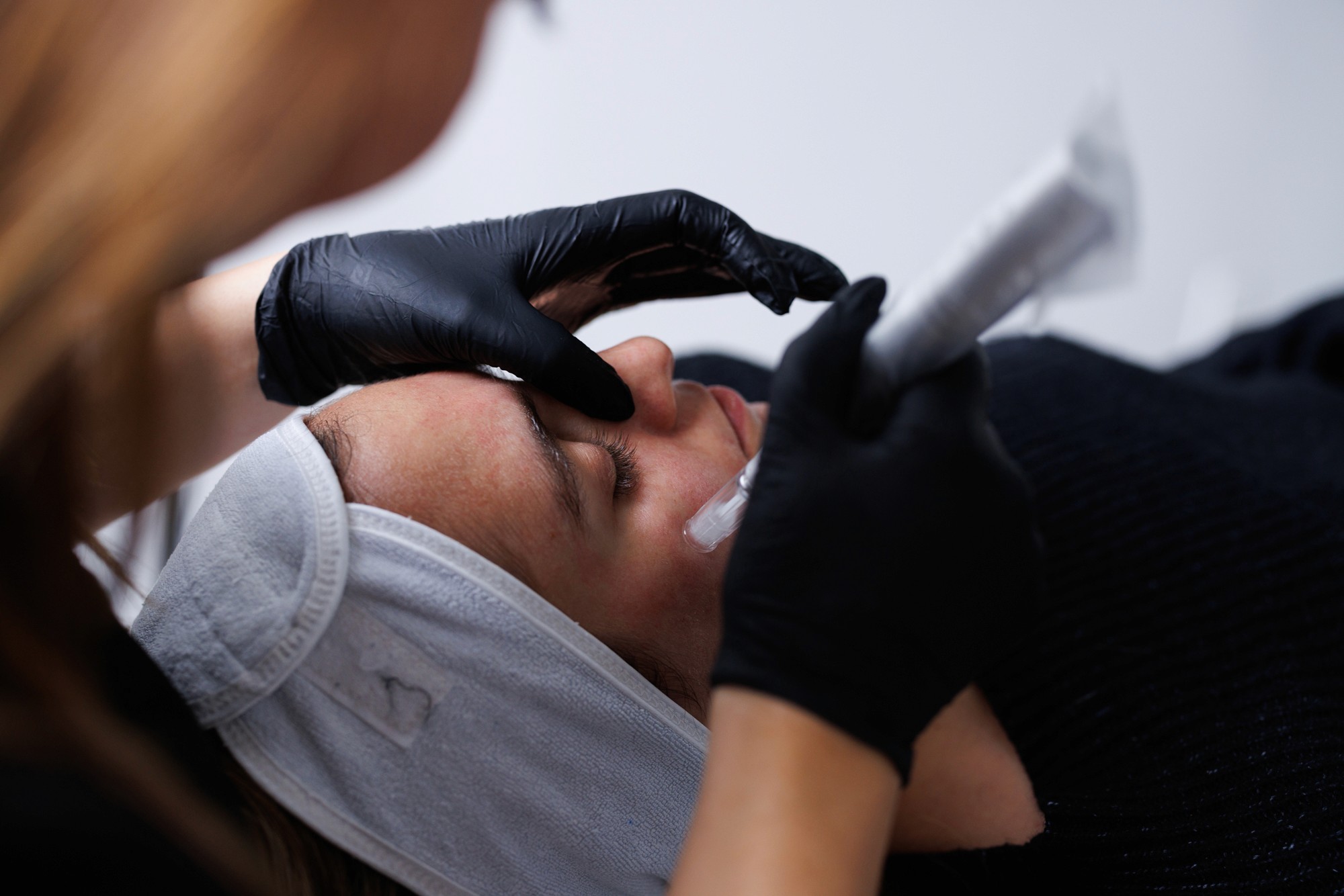 Patiente couchée avec l'outil de microneedling au visage