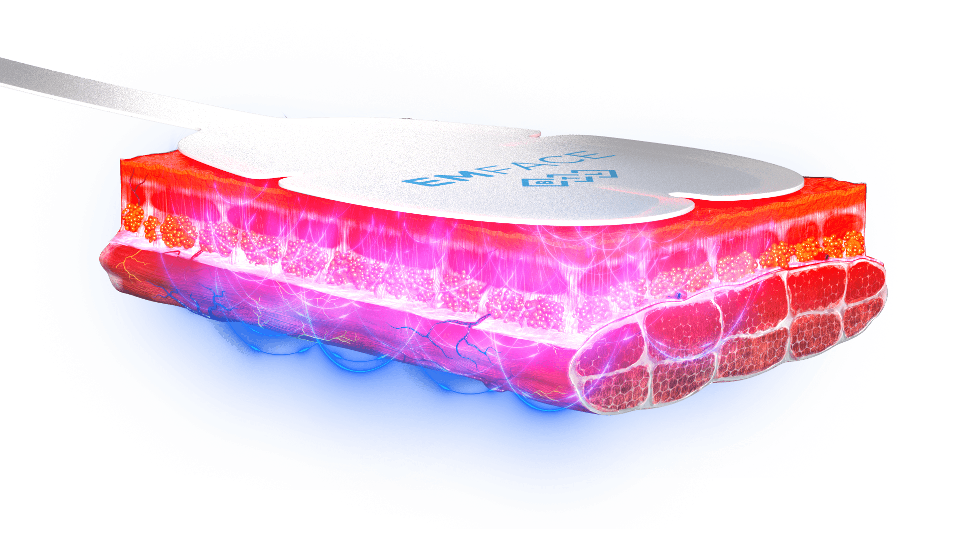 EMFACE device emitting energy into skin and muscle tissue layers illustration