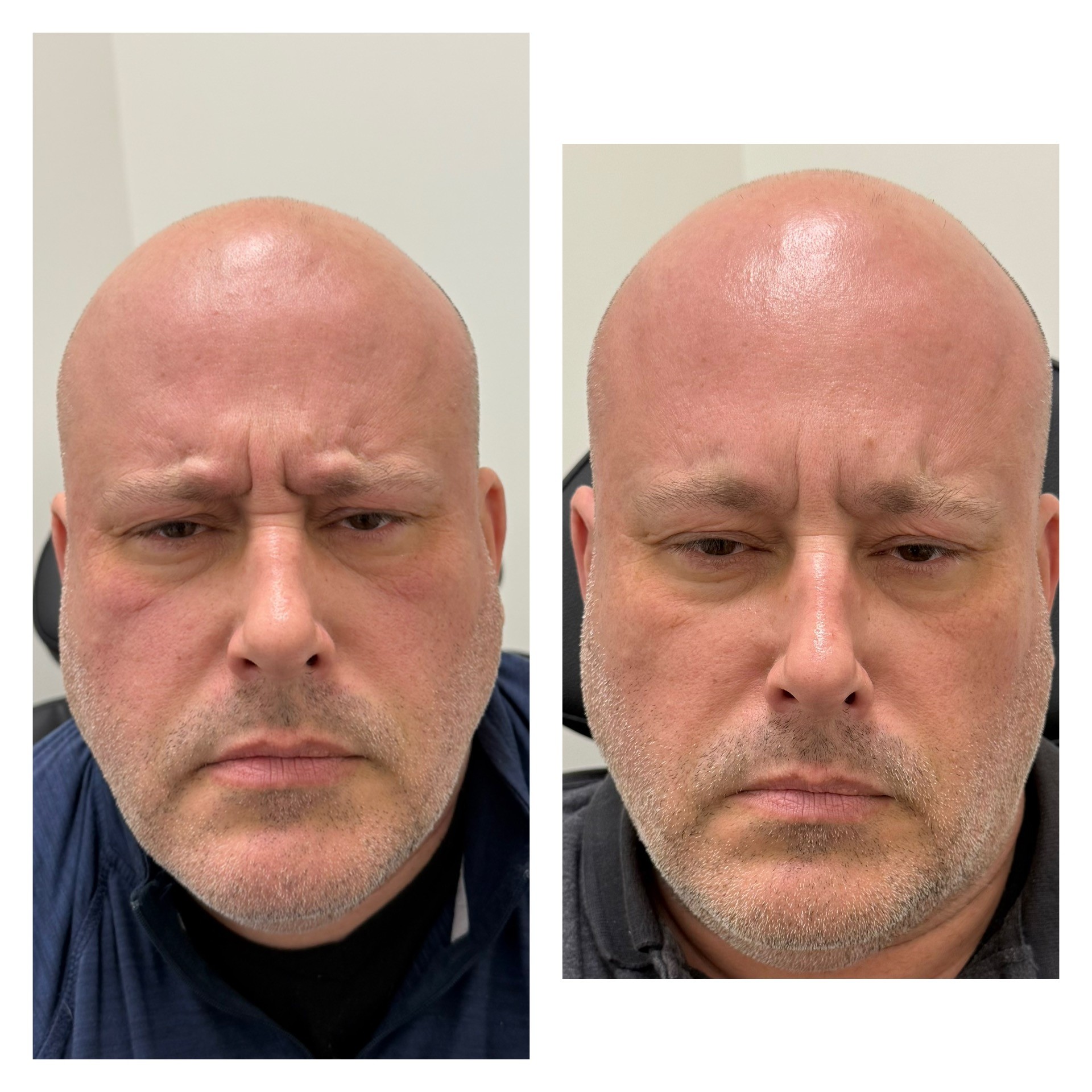 mans botox hagerstown md