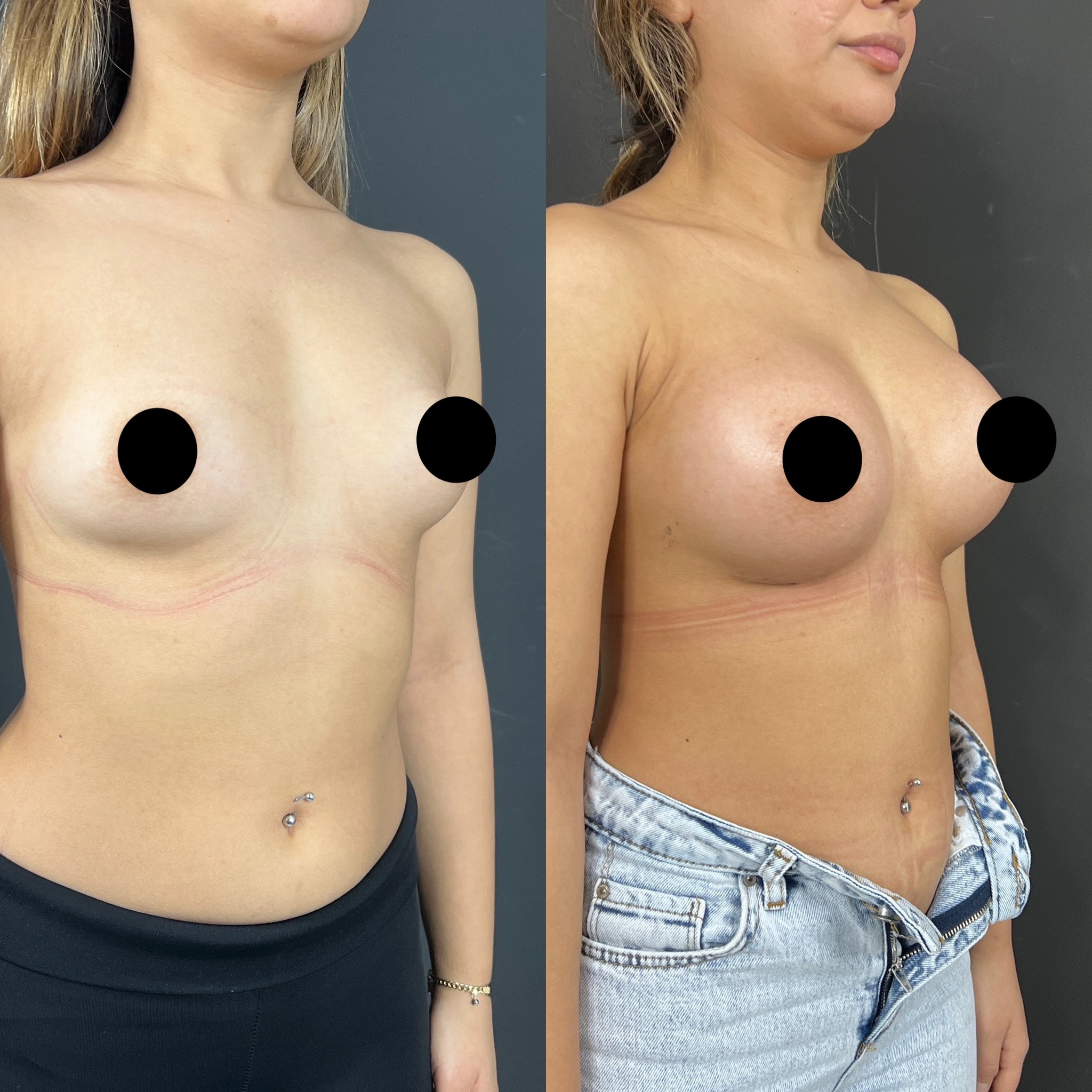 3 months breast implant before after right oblique view