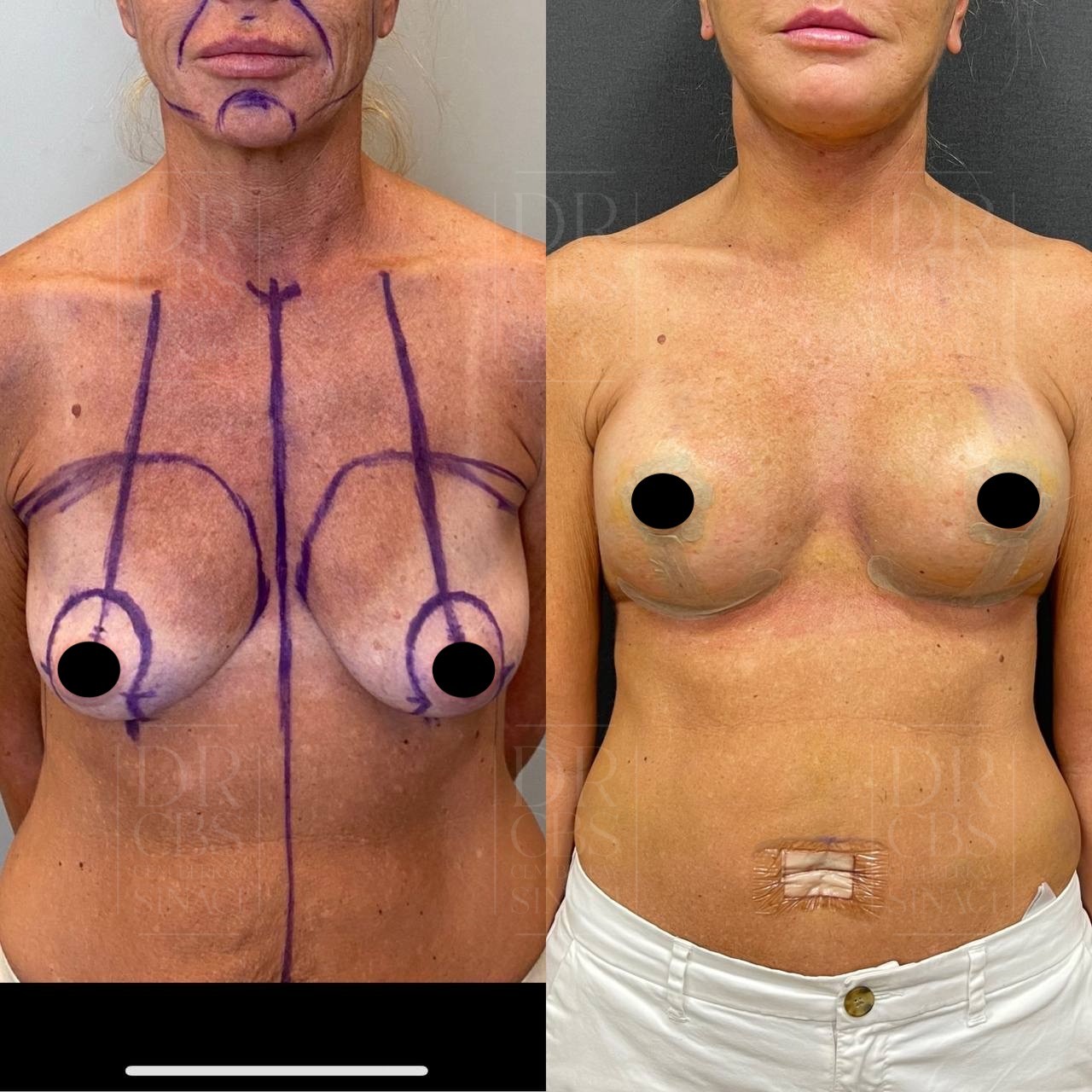 breast lift with implant before after 4th day result