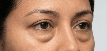 Browlift