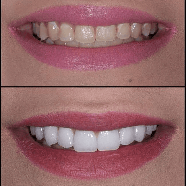 Before and after images of dental veneers in Dubai, showing enhanced symmetry, healthier-looking teeth, and refined contours.