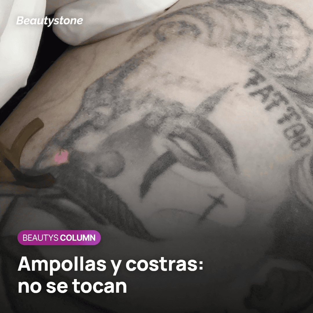Ampollas y costras tras eliminar un tatuaje con PicoWay