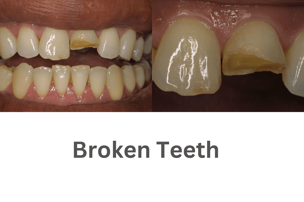 Cracked or Broken Tooth